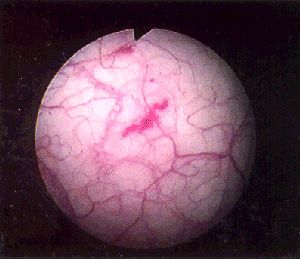 Interstitial Cystitis Bladder Photo, Picture & Video Archive.